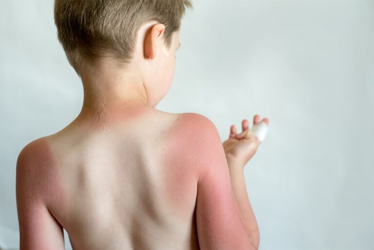 Common Skin Rashes In Children Pediatricians Advice On Managing Them
