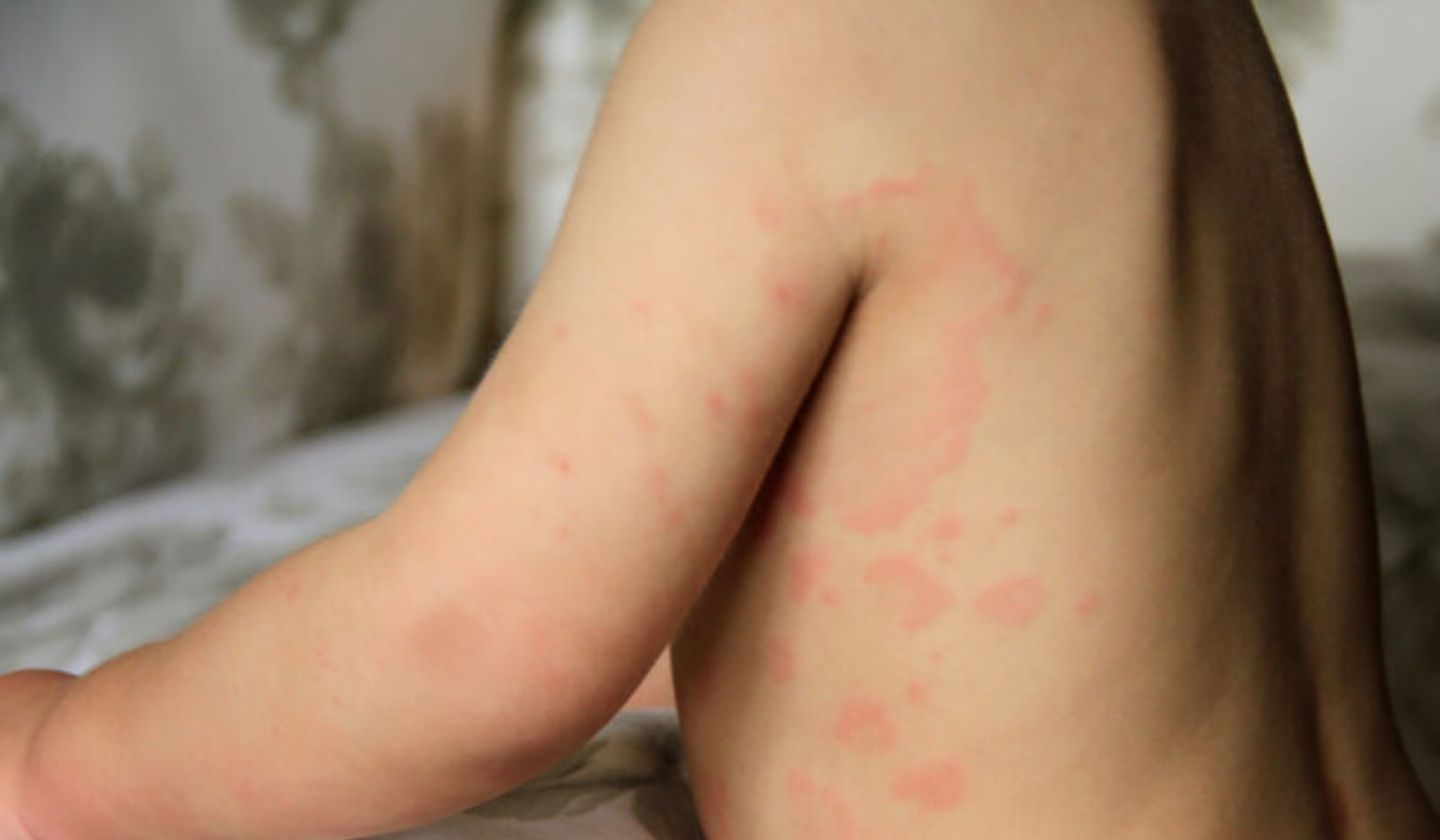 hives in children
