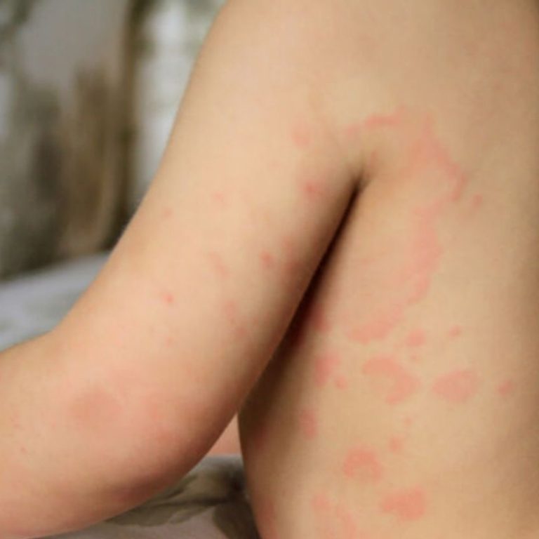 hives in children