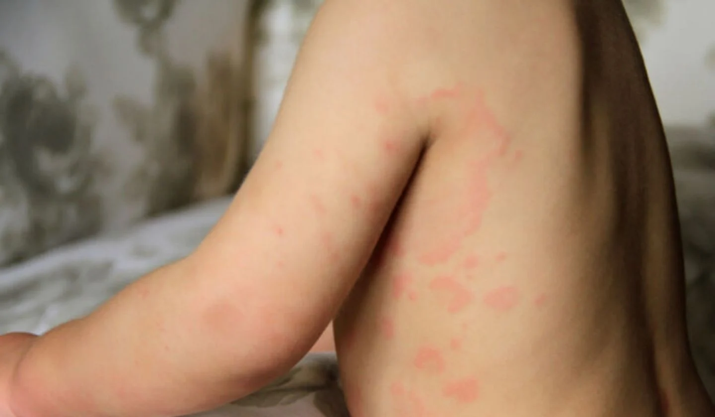 hives in children